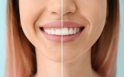 Lečenje gummy smile laserom Biolase Epic X u Novom Sadu